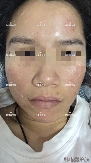 膿包痘祛痘效果，擁有干凈的臉不等待！