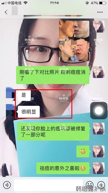 敏感肌粉刺痘痘全部消下去了,痘坑也修復平整了一部分