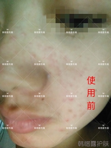 額頭長痘臉頰長痘痘粉刺，這樣調理幫你恢復嫩白肌膚！