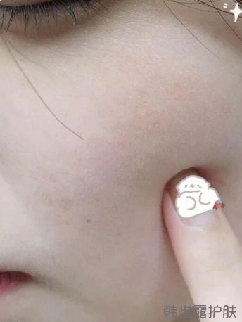 反復長痘這么多年，你需要找準痘因？