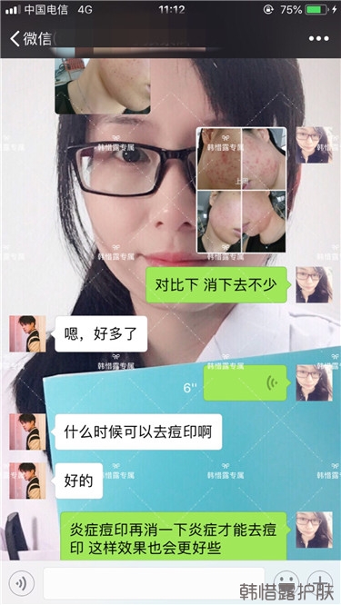 痘痘好多了,認真聽話按照要求使用,每個人都可以變很美!