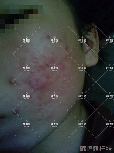 祛痘后判若兩人，膿包痘消了變小仙女