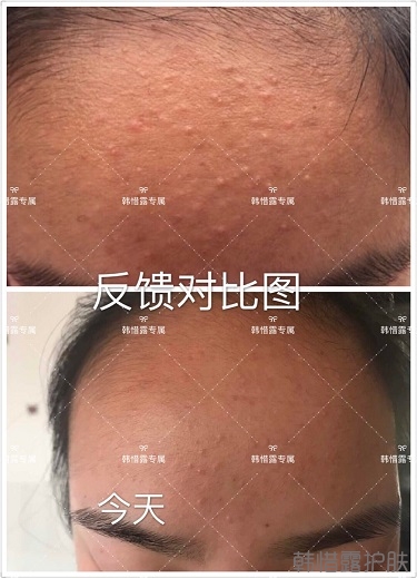 粉刺怎么辦？粉刺去除反饋：不要被粉刺遮住光潔的額頭