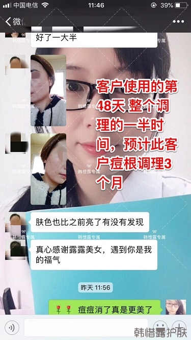 臉上一直長痘痘膿包怎么解決?痘痘開始消了,更美麗!