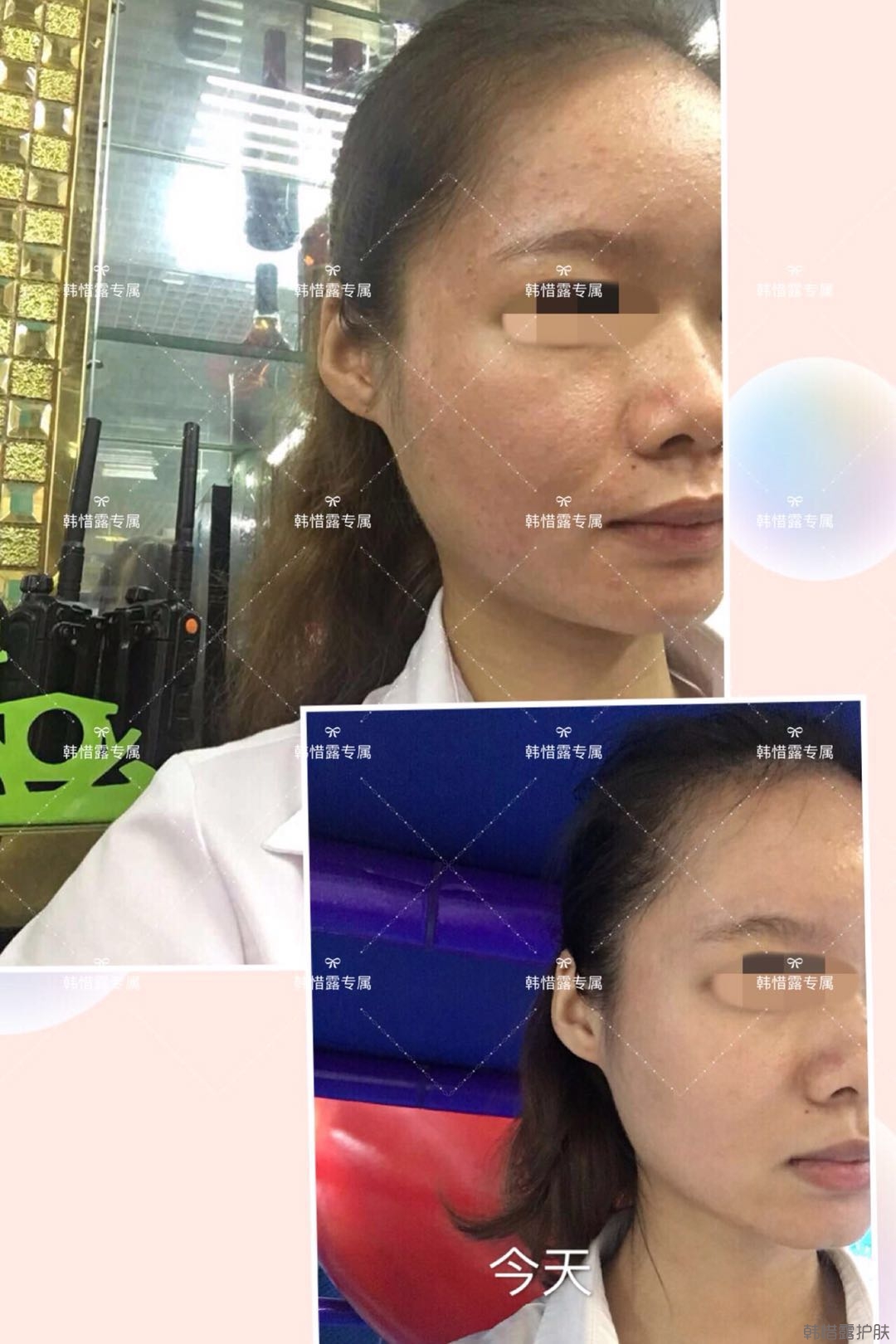 閉口粉刺怎么去除?嚴格按要求使用，粉刺效果不錯！