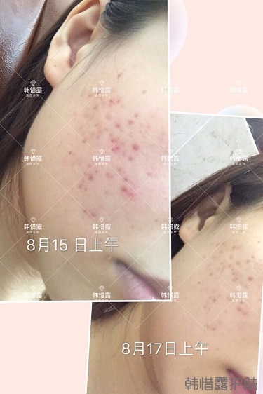 祛痘,痘痘發炎痘印就選它!