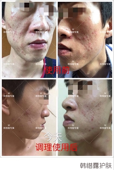 長痘痘找韓惜露，祛痘效果反饋