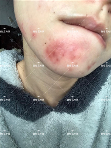 【視頻】臉上長粉刺怎樣去掉？醫院都沒搞定韓惜露幫我搞定了，超級開心！