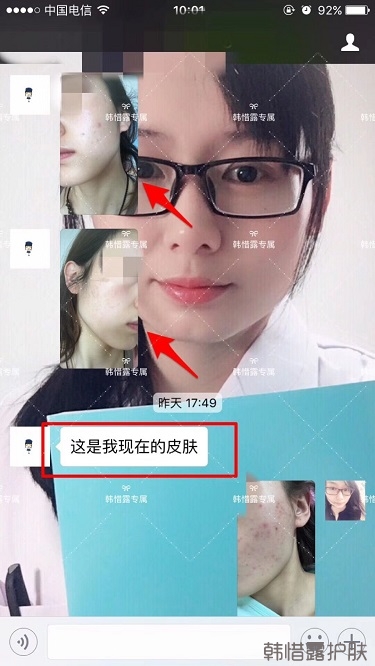 痘痘好了皮膚美麗,不想再記起曾經滿臉痘痘的自己!