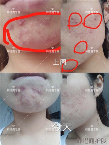 粉刺只剩一點點了,敏感肌粉刺修復,更美麗!