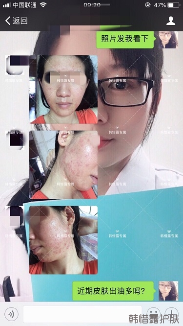 激素臉滿臉粉刺痘痘到光滑健康肌膚的蛻變