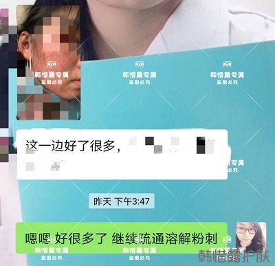 臉上長(zhǎng)閉口粉刺怎么去除,粉刺消下去了，皮膚變好了