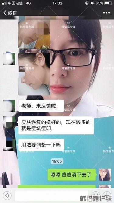 好好使用，膿包痘痘,小粉刺全消了,重點修復痘印痘坑印了