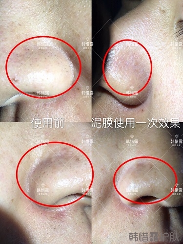 疏通毛孔泥膜去黑頭效果,效果顯著