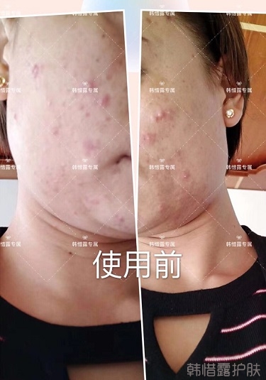 臉上一直長痘痘膿包怎么解決?痘痘開始消了,更美麗!