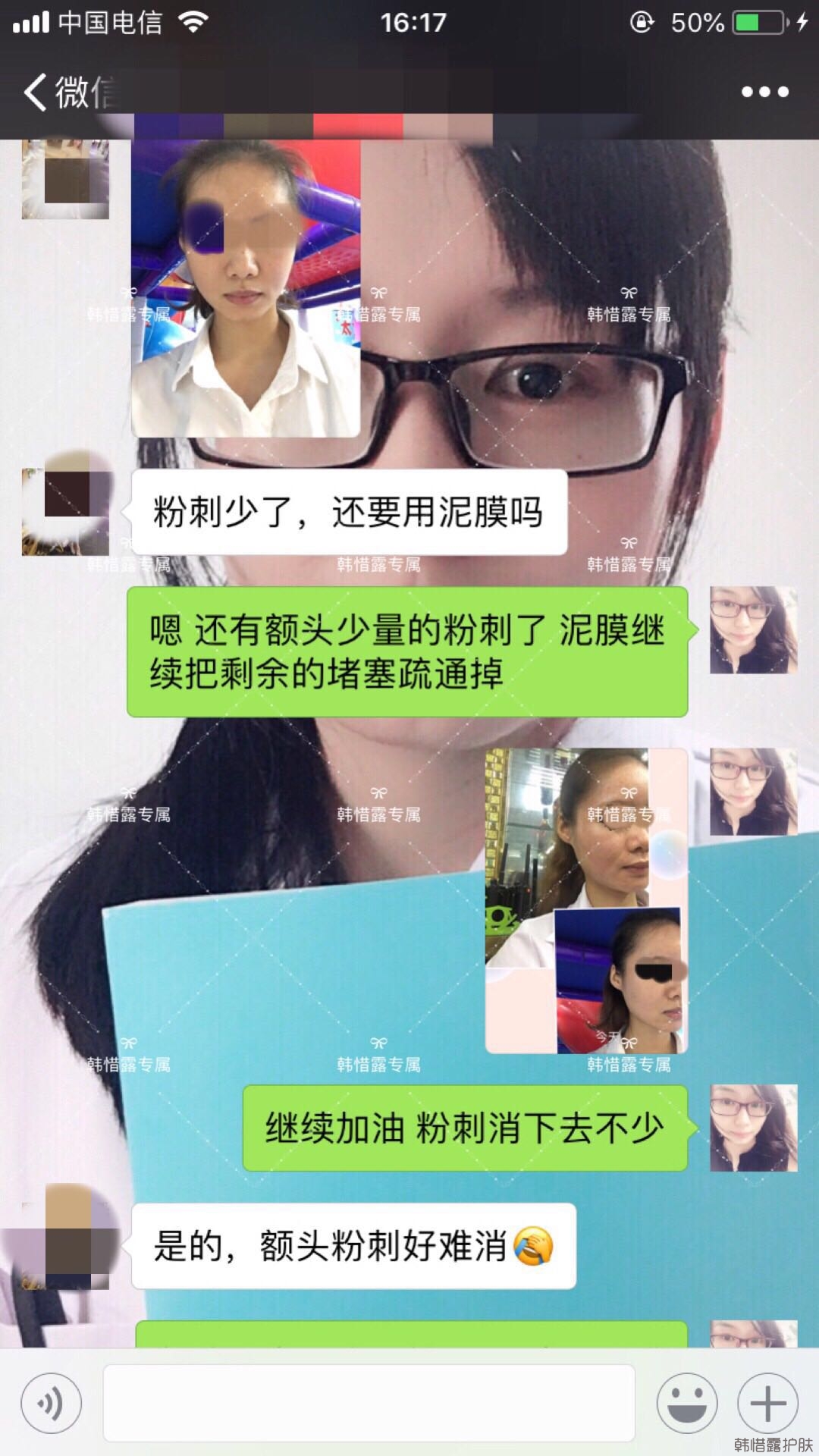 閉口粉刺怎么去除?嚴格按要求使用，粉刺效果不錯！