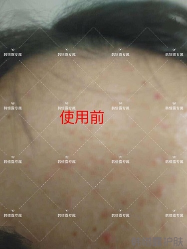 額頭長痘臉頰長痘痘粉刺，這樣調理幫你恢復嫩白肌膚！