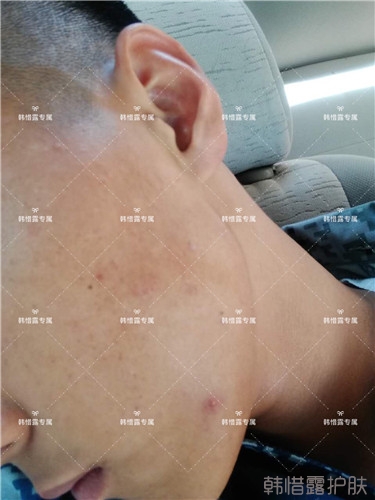 粉刺消了，皮膚光滑了，變帥氣不少呦！