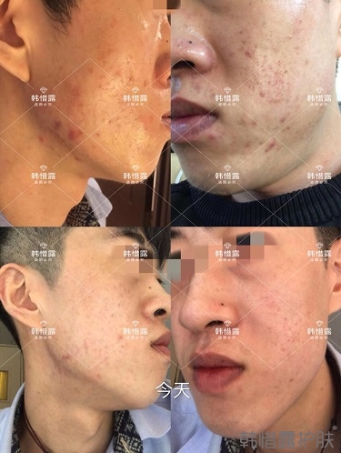 敏感肌粉刺痘痘全部消下去了,痘坑也修復平整了一部分