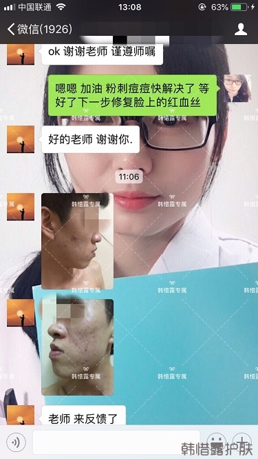 長痘痘找韓惜露，祛痘效果反饋