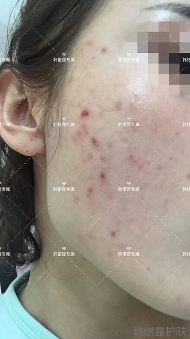 痘痘好了皮膚美麗,不想再記起曾經滿臉痘痘的自己!