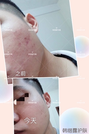 粉刺、痘痘、痘印、統(tǒng)統(tǒng)解決啦！祛痘去粉刺就是這么簡單！