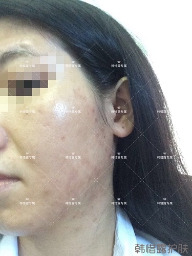 激素臉滿臉粉刺痘痘到光滑健康肌膚的蛻變