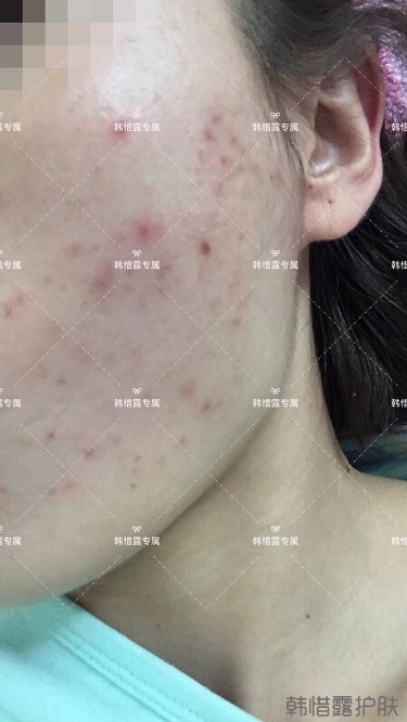 痘痘好了皮膚美麗,不想再記起曾經滿臉痘痘的自己!