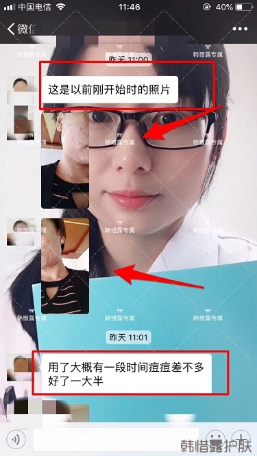 臉上一直長痘痘膿包怎么解決?痘痘開始消了,更美麗!