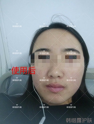 額頭長痘臉頰長痘痘粉刺，這樣調理幫你恢復嫩白肌膚！