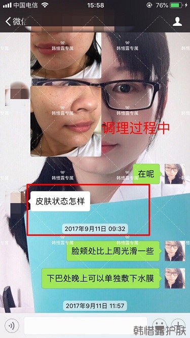 粉刺密密麻麻,試過(guò)很多方法無(wú)果后找韓惜露老師輕松去掉粉刺!