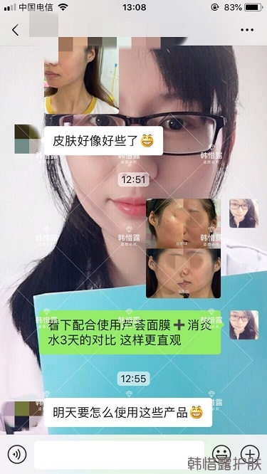 3天痘痘好多了，開心