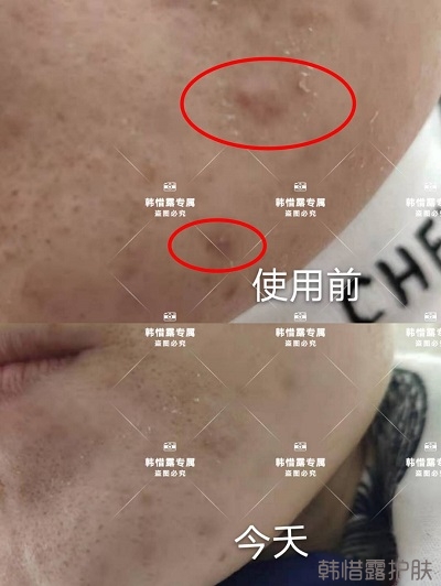 怎么消除臉上的痘痘,發(fā)硬膿包消下去了