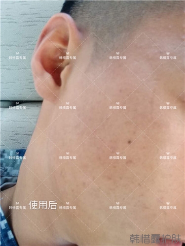 粉刺消了，皮膚光滑了，變帥氣不少呦！