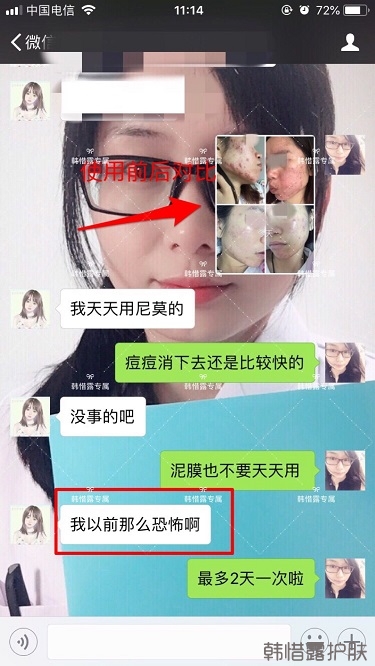 膿包痘祛痘效果，擁有干凈的臉不等待！