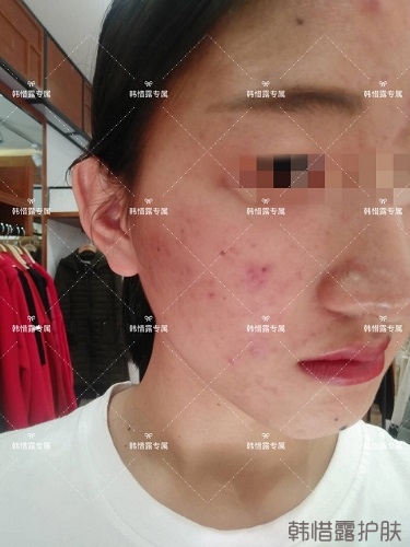 臉上長痘痘怎么去掉？徹底告別痘痘，自卑到自信的蛻變！