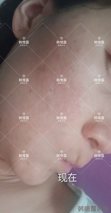 化妝品店主的變臉級祛痘反饋,粉刺痘痘全部消了