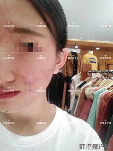 臉上長痘痘怎么去掉？徹底告別痘痘，自卑到自信的蛻變！