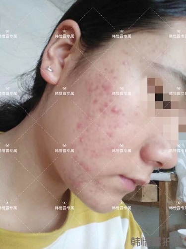 好好使用，膿包痘痘,小粉刺全消了,重點修復痘印痘坑印了