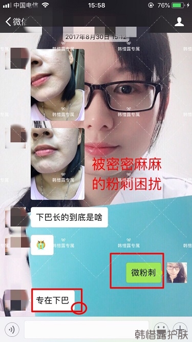 粉刺密密麻麻,試過(guò)很多方法無(wú)果后找韓惜露老師輕松去掉粉刺!