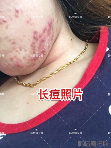 下巴長痘怎么辦？看這里徹底去掉痘痘，不再長痘了！