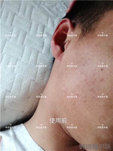 粉刺消了，皮膚光滑了，變帥氣不少呦！