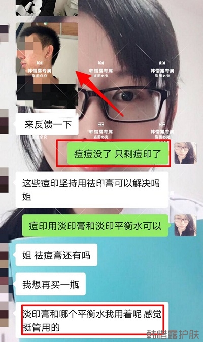 痘印怎么去？痘印調(diào)理案例，痘印淡化了