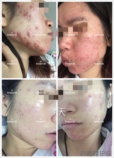 膿包痘祛痘效果，擁有干凈的臉不等待！