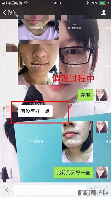 粉刺密密麻麻,試過(guò)很多方法無(wú)果后找韓惜露老師輕松去掉粉刺!