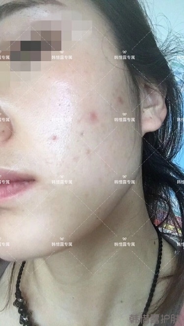 痘痘好了皮膚美麗,不想再記起曾經滿臉痘痘的自己!