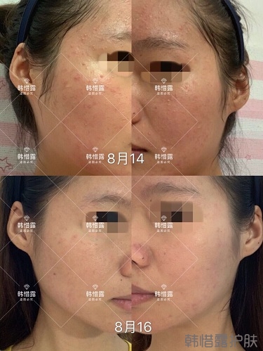 3天痘痘好多了，開心