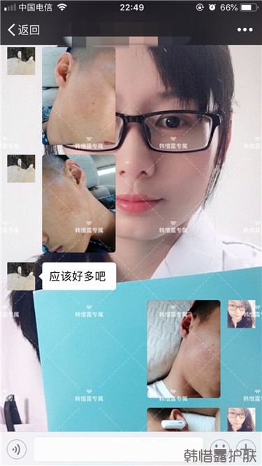 粉刺消了，皮膚光滑了，變帥氣不少呦！