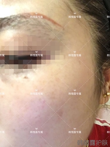 下巴長痘怎么辦？看這里徹底去掉痘痘，不再長痘了！