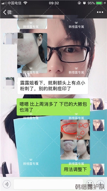 粉刺只剩一點點了,敏感肌粉刺修復,更美麗!